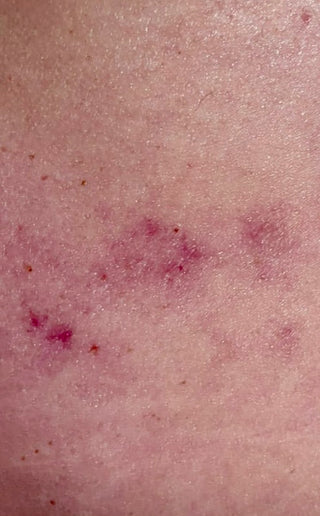 Customer skin with red marks before the treatment with Natalie's better aging lotion