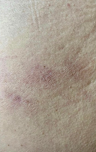 Customer skin with much lighter marks after treatment with Natalie's better aging lotion