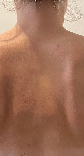 Customer back without any impurities after treatment with Natalie's purity body lotion