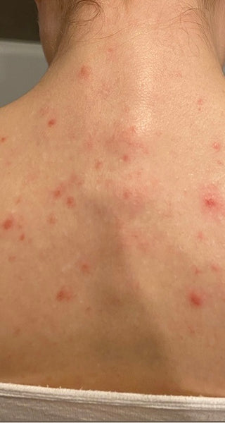 Customer back with impurities before treatment with Natalie's purity body lotion