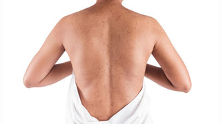 Body Acne