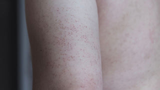 Keratosis Pilaris